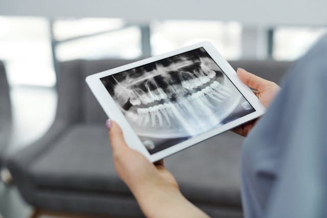 Tooth Extractions