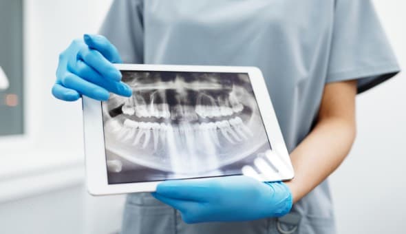 Dental Implants